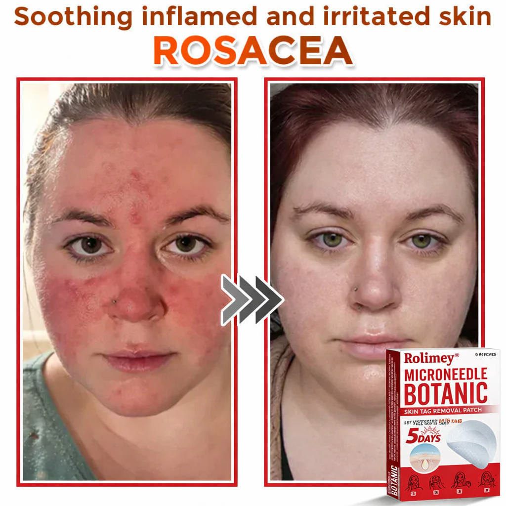 🌈Rolimey® MicroNeedle Botanic Skin Tag Removal Patch 🇺🇸 Made in the USA