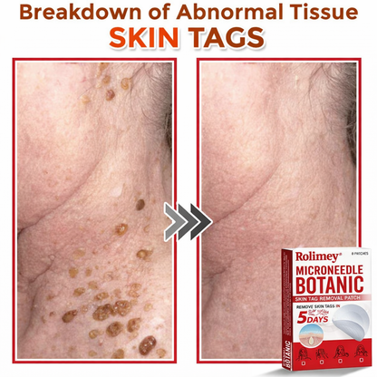 🌈Rolimey® MicroNeedle Botanic Skin Tag Removal Patch 🇺🇸 Made in the USA