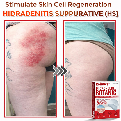 🌈Rolimey® MicroNeedle Botanic Skin Tag Removal Patch 🇺🇸 Made in the USA